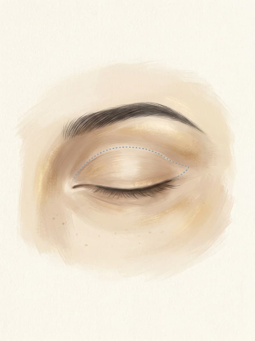 Blefaroplastia superior