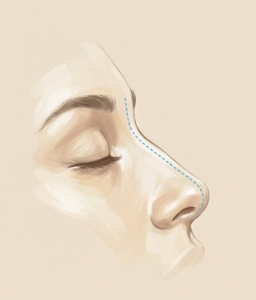 Rinoplastia preservadora